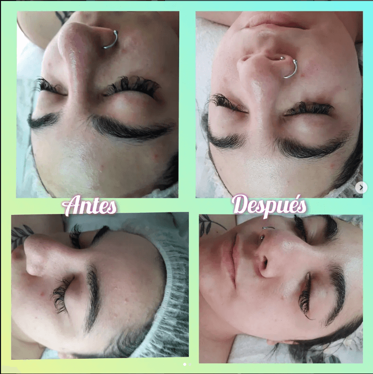 Resultado real de tratamiento estético - Eugenia Style Antes y Después 5