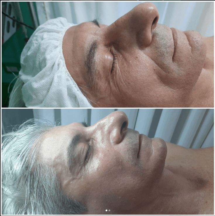 Resultado real de tratamiento estético - Eugenia Style Antes y Después 7