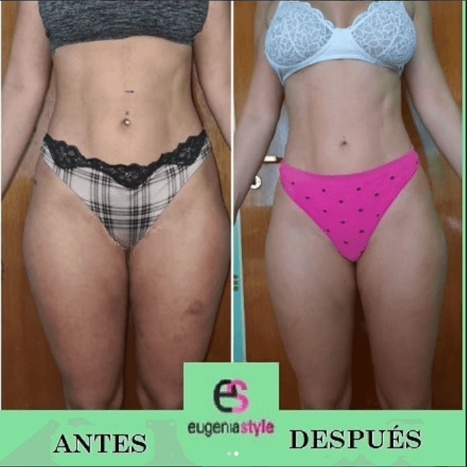 Resultado real de tratamiento estético - Eugenia Style Antes y Después 11