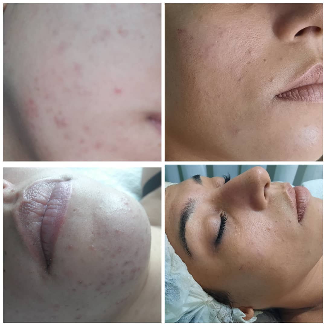 Resultado real de tratamiento estético - Eugenia Style Antes y Después 17