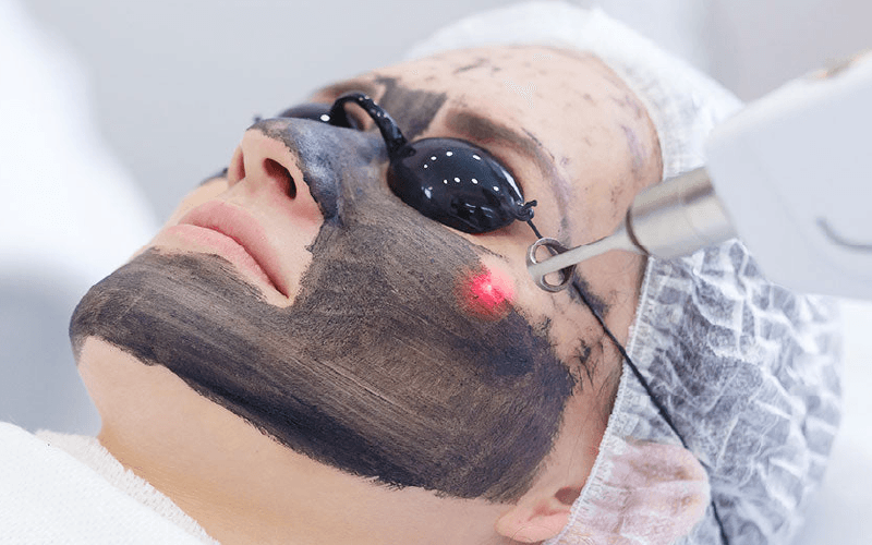 Tratamiento de Hollywood Peel - Eugenia Style Estética